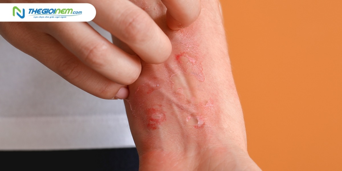 Nằm nệm bị ngứa phải làm sao?
