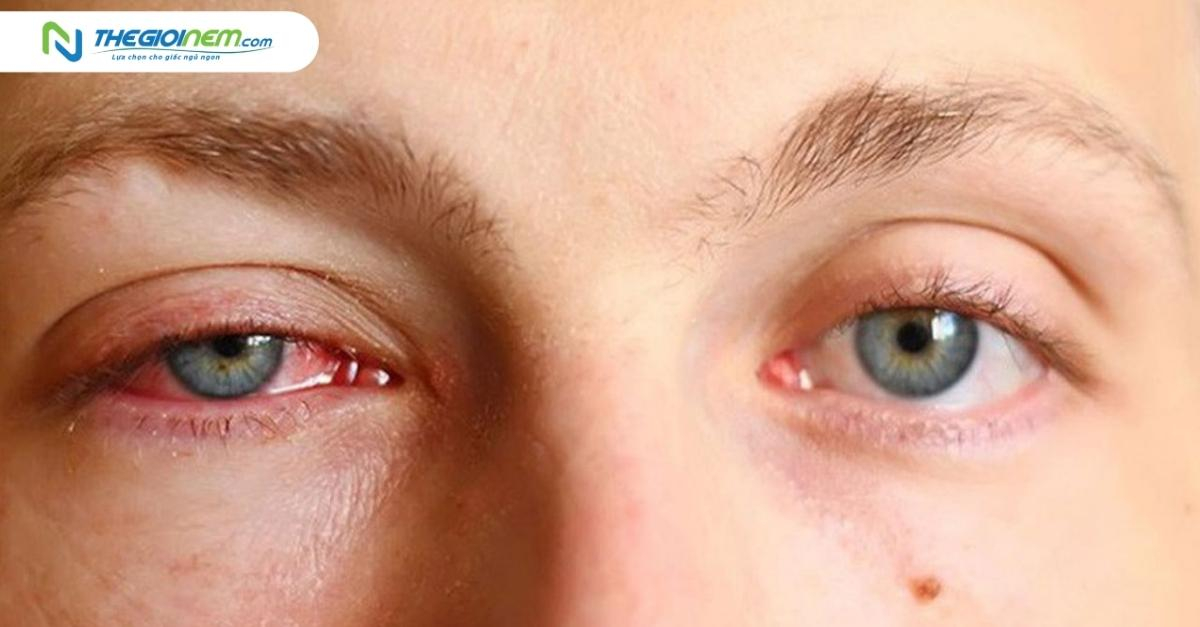 Đau mắt đỏ là gì? nguyên nhân, triệu chứng và cách phòng ngừa